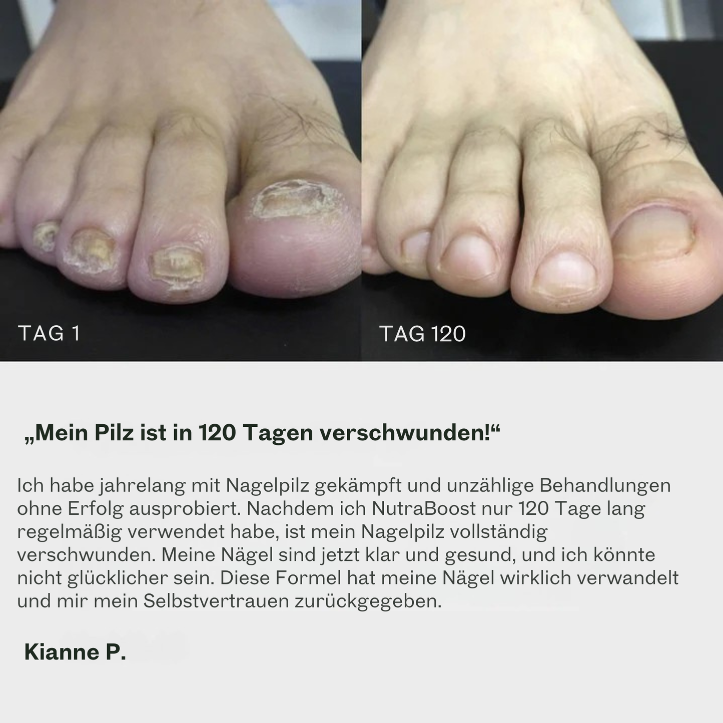 Behandlungsgel gegen Nagelpilz